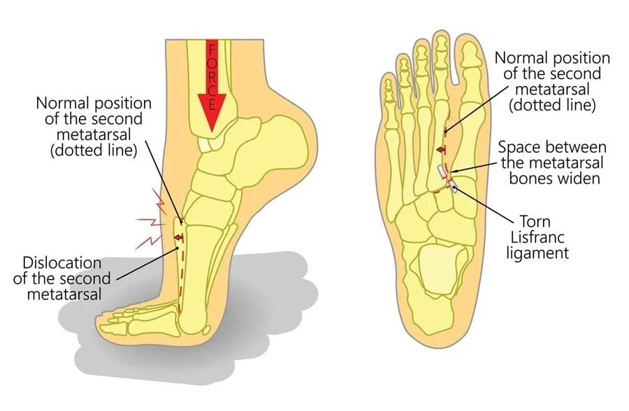 lisfranc fracture