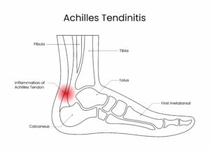 foot musculoskeletal structure, depicting inflammation of the Achilles tendon