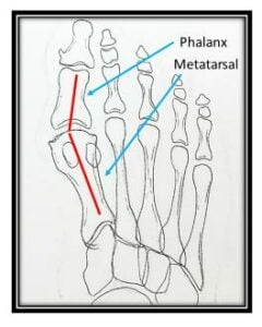 Example of bunions shown via bone