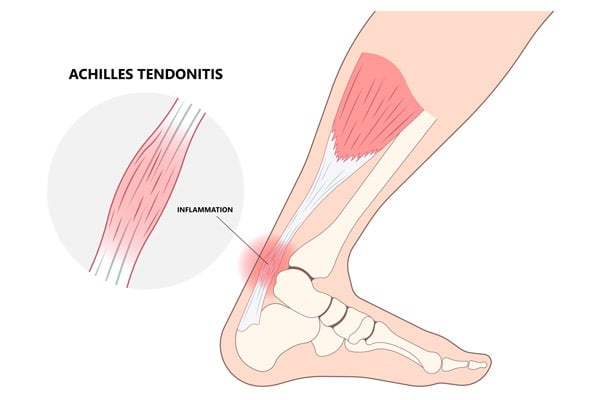 Insertional Achilles Tendinitis