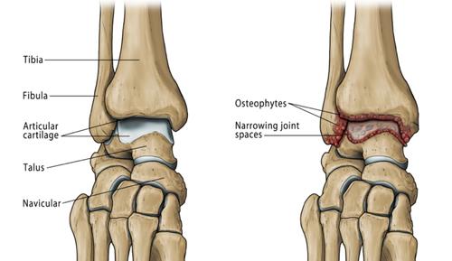 ankle arthritis