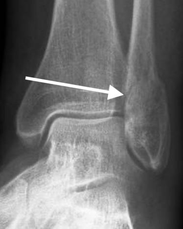x-ray ankle fracture