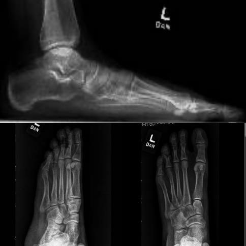 ankle fracture x-ray