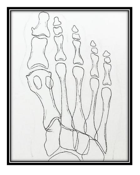 x-ray sesamoiditis and sesamoid fractures
