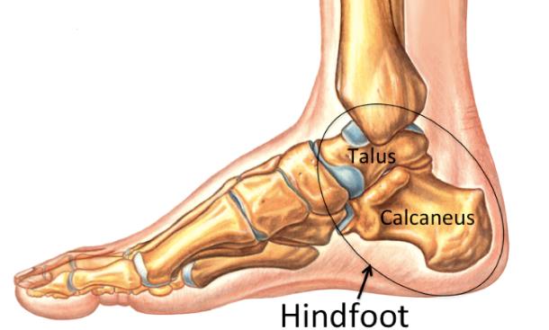 hindfoot structure